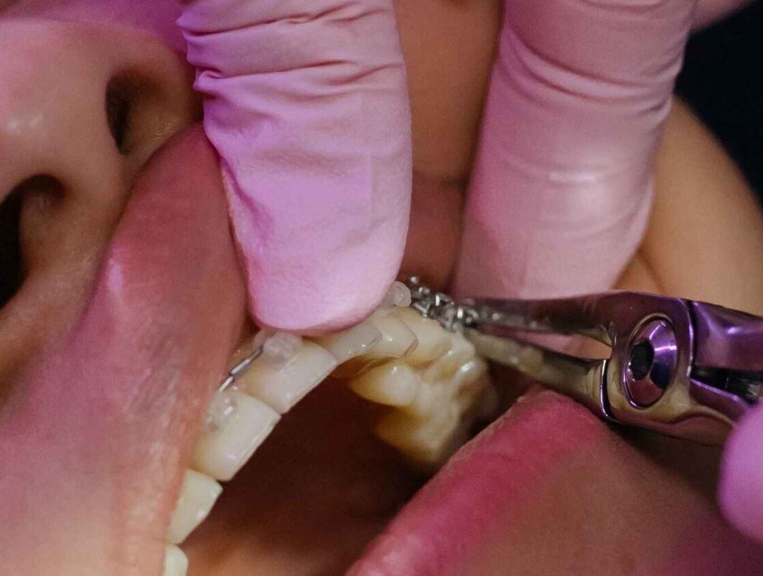 tooth-extraction