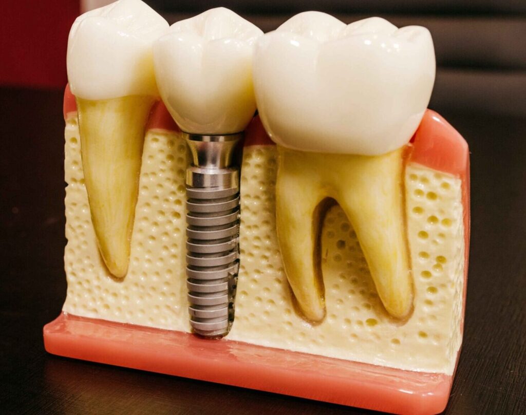 dental-implants